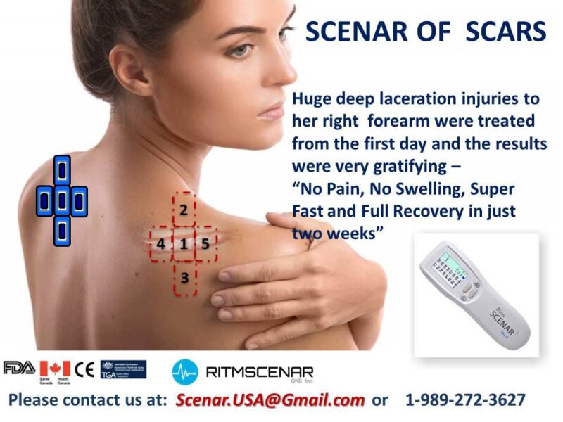 SCENAR therapy poster demonstrating scar treatment and recovery