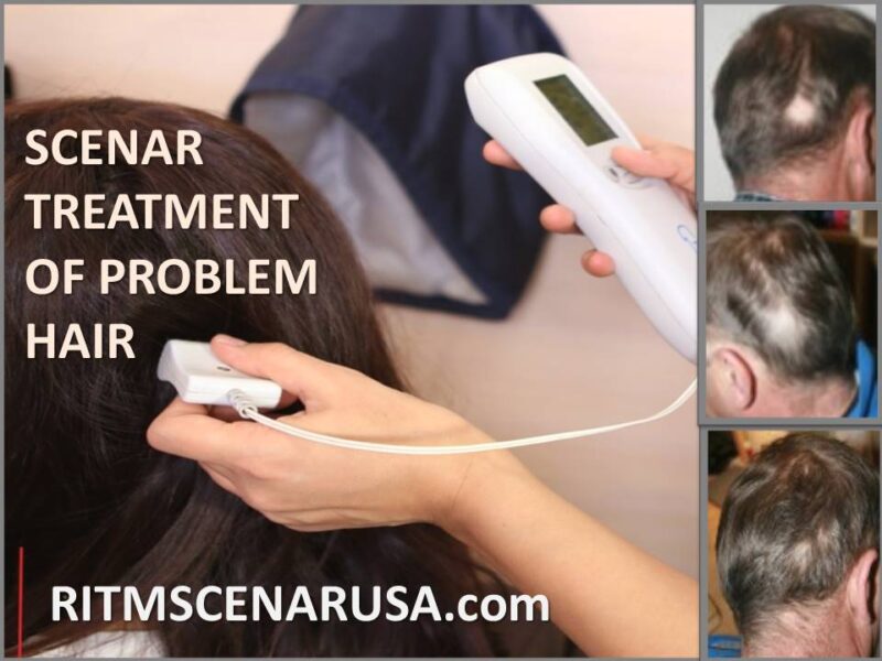 SCENAR treatment for hair loss with device application