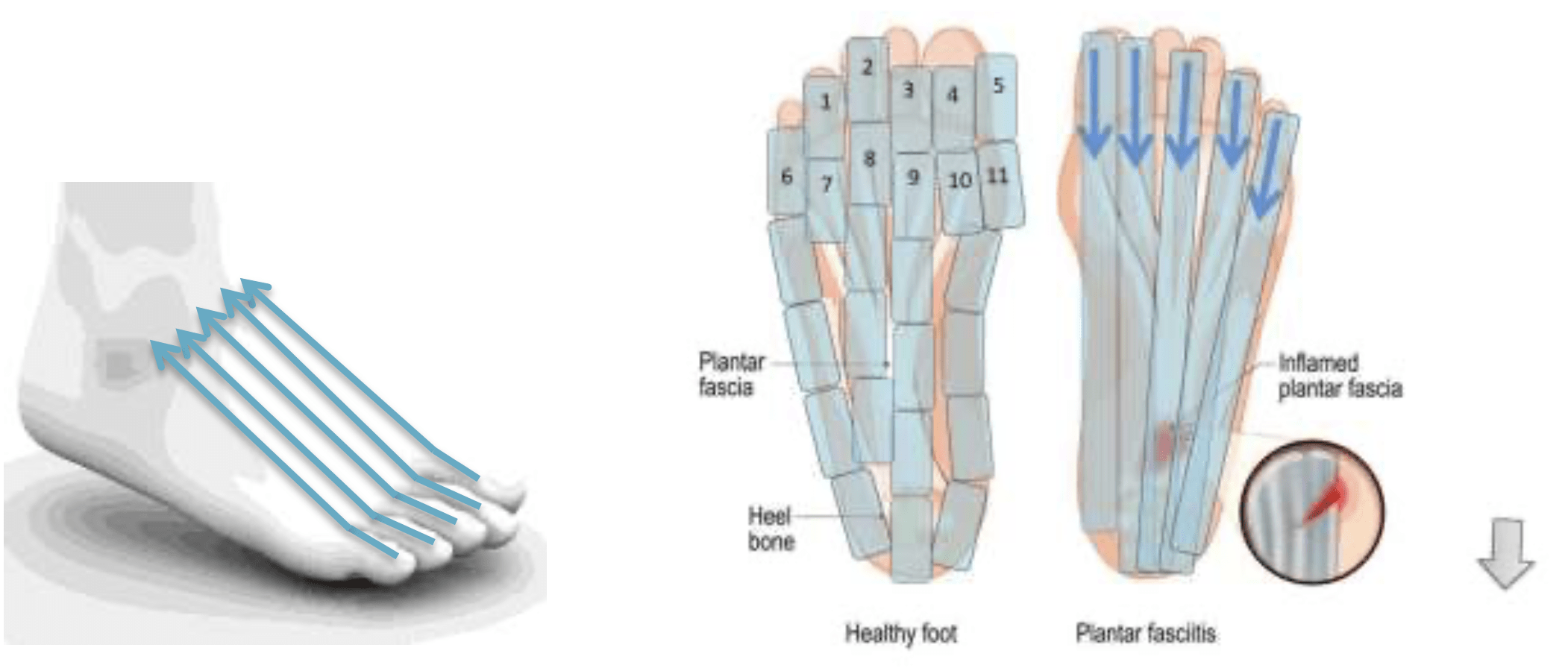 RITMSCENAR®can successfully relieve the pain of plantar fasciitis.