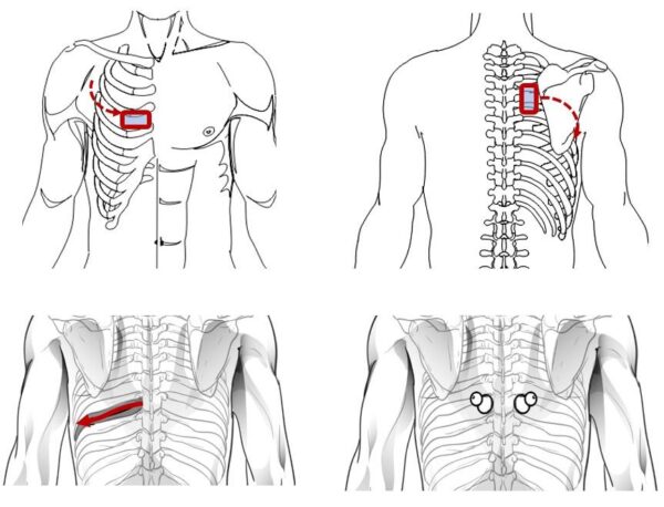 3) Device settings: F=120Hz, Int-7 or SCENAR FORCE Preset “PoinPain”. and, tightly pressing the built-in electrode to the skin, treat the segment corresponding to the intercostal space from the spine to the chest (as shown in the figure).