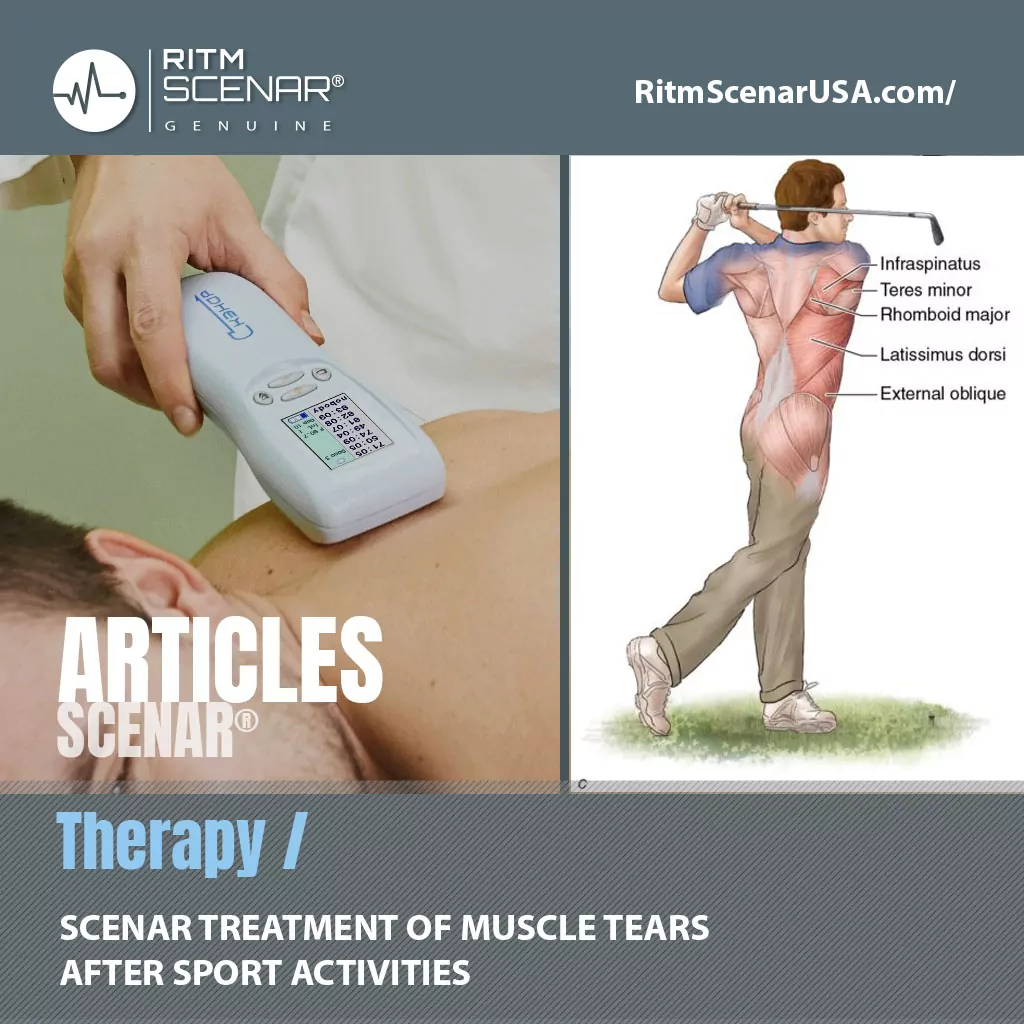 SCENAR TREATMENT OF MUSCLE TEARS AFTER SPORT ACTIVITIES